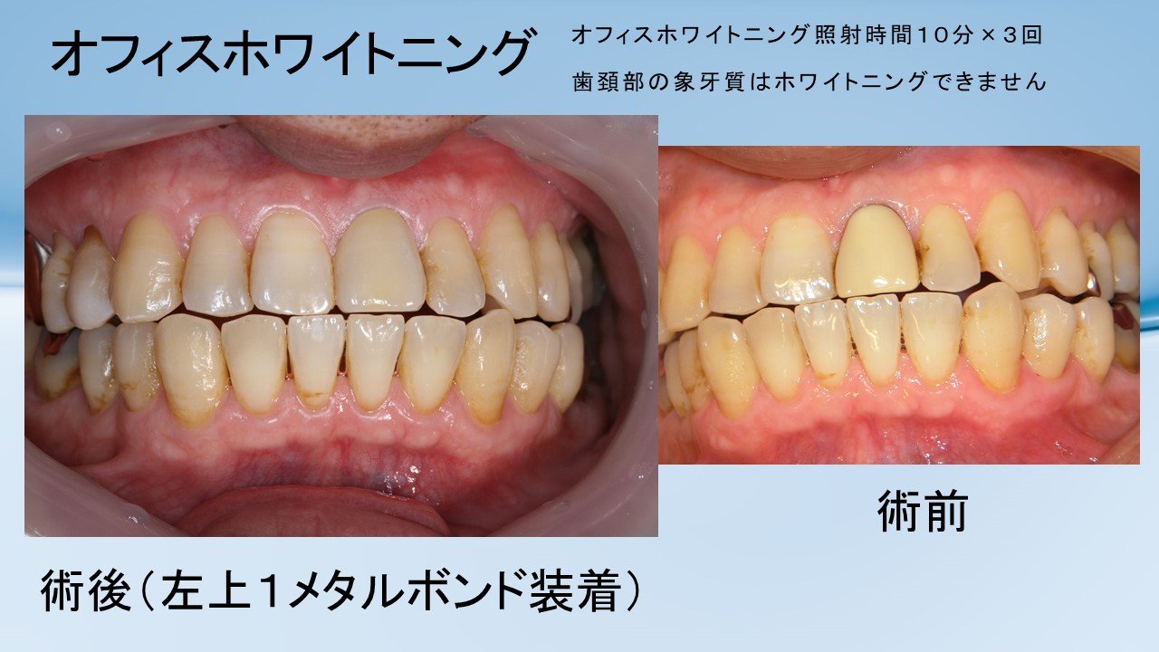 する 中学生 を 方法 白く 歯